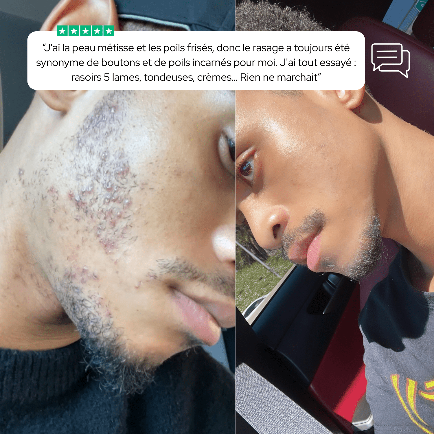 KIT DE RASAGE ANTI - IRRITATIONS COMPLET– ZÉRO FEU DU RASOIR & POILS INCARNÉS pour homme – rasage de précision sans irritation | Barbenoire