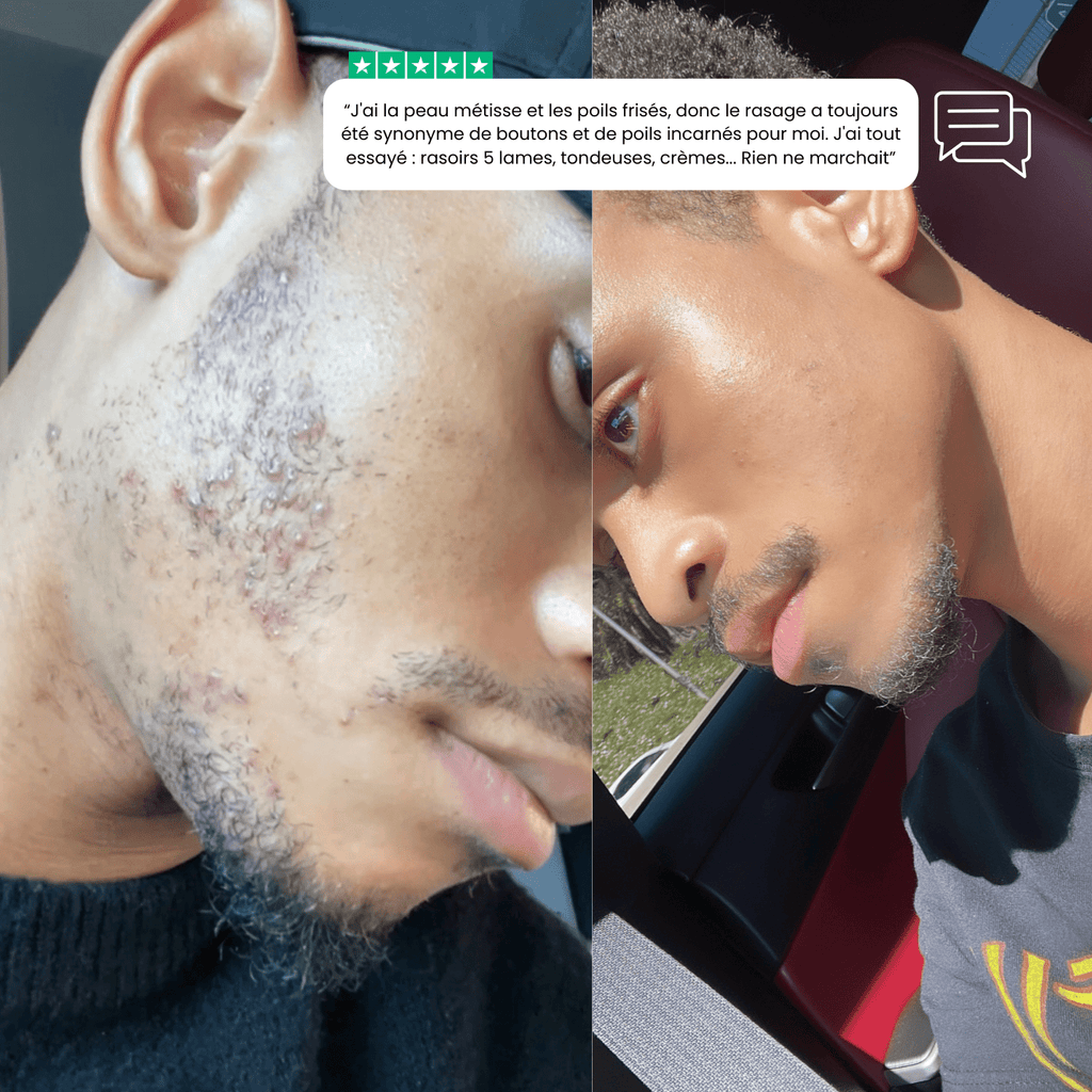 KIT DE RASAGE ANTI - IRRITATIONS COMPLET– ZÉRO FEU DU RASOIR & POILS INCARNÉS pour homme – rasage de précision sans irritation | Barbenoire
