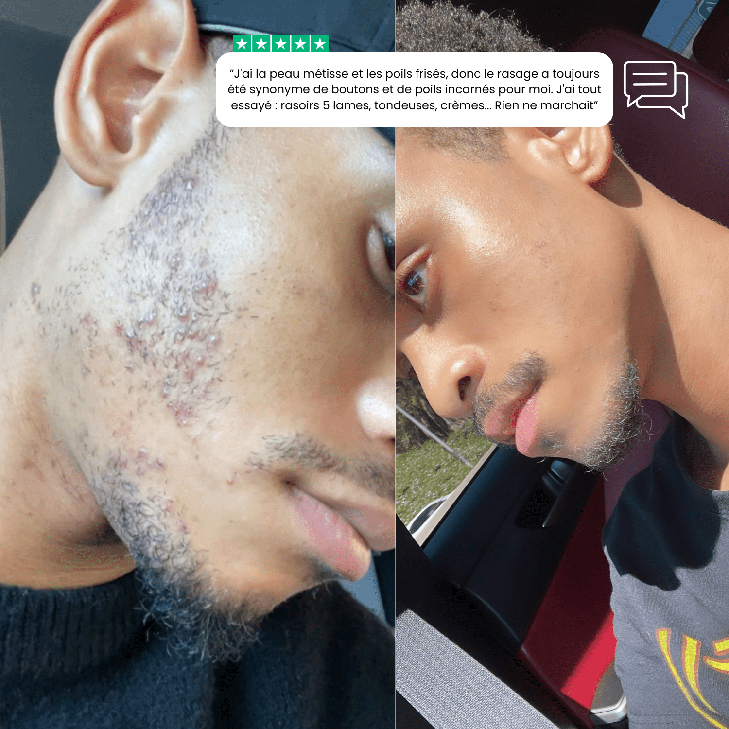 KIT DE RASAGE ANTI - IRRITATIONS COMPLET– ZÉRO FEU DU RASOIR & POILS INCARNÉS pour homme – rasage de précision sans irritation | Barbenoire